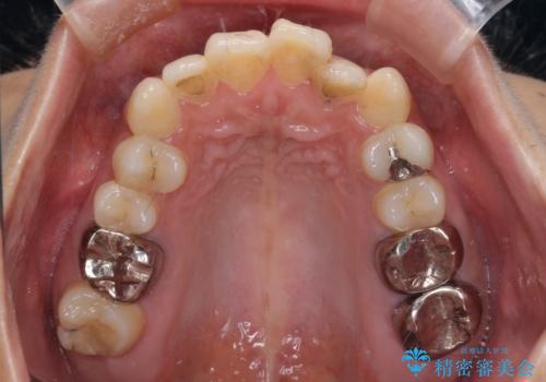 ワイヤー装置の抜歯矯正で横顔の口元の印象をすっきりとの治療前