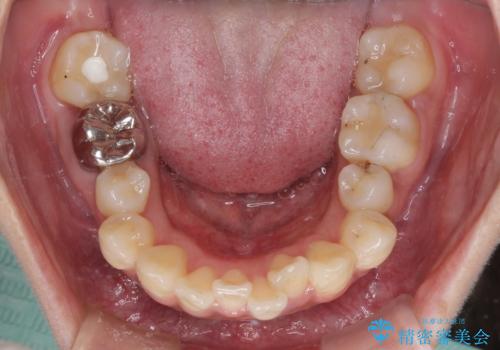 ワイヤー装置の抜歯矯正で横顔の口元の印象をすっきりとの治療前