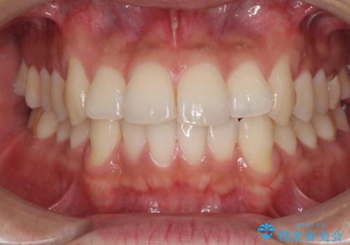 前歯のデコボコを治したい インビザライン矯正治療の症例 治療前