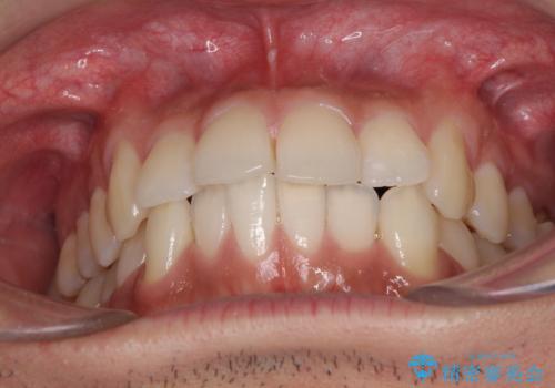 前歯のデコボコを治したい インビザライン矯正治療の治療前