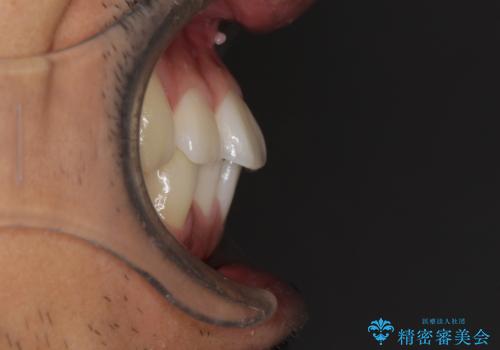 前歯のデコボコを治したい インビザライン矯正治療の治療前