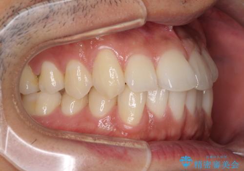 前歯のデコボコを治したい インビザライン矯正治療の治療前