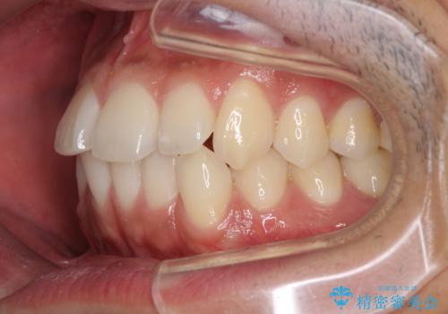 前歯のデコボコを治したい インビザライン矯正治療の治療前