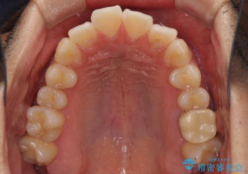 前歯のデコボコを治したい インビザライン矯正治療の治療前