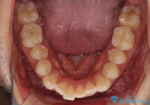 前歯のデコボコを治したい インビザライン矯正治療の治療前