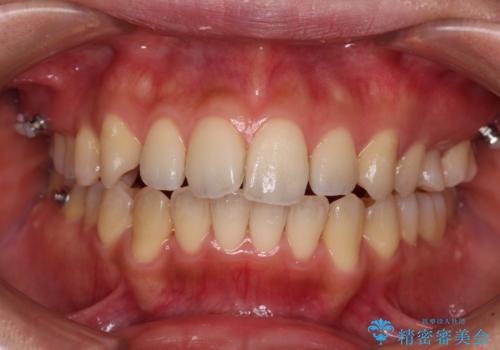 残存乳歯とオープンバイト　インビザラインによる矯正治療の治療中