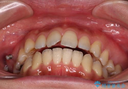 残存乳歯とオープンバイト インビザラインによる矯正治療の治療中