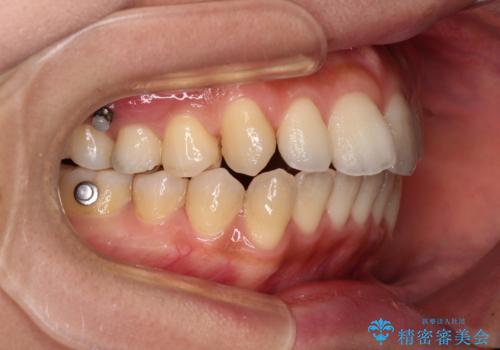 残存乳歯とオープンバイト インビザラインによる矯正治療の治療中