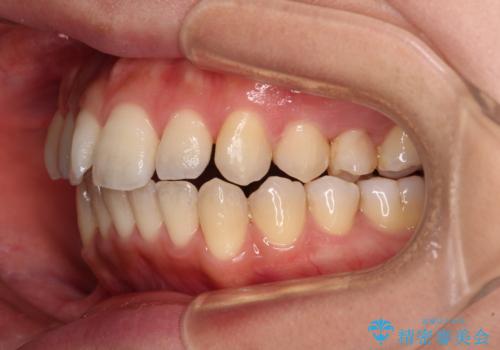 残存乳歯とオープンバイト インビザラインによる矯正治療の治療中