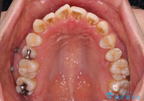 残存乳歯とオープンバイト インビザラインによる矯正治療の治療中