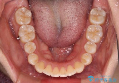 残存乳歯とオープンバイト インビザラインによる矯正治療の治療中