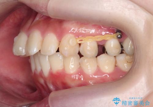 [ 出っ歯を治したい ]　マイクロインプラントを用いた大きな後方移動の治療中