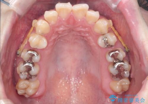 [ 出っ歯を治したい ]　マイクロインプラントを用いた大きな後方移動の治療中