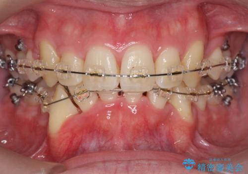 前歯のがたつき　下の八重歯の治療中