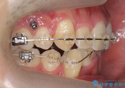 前歯のがたつき 下の八重歯の治療中