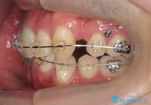 前歯のがたつき 下の八重歯の治療中