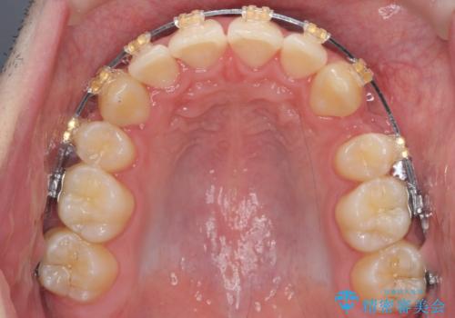 前歯のがたつき 下の八重歯の治療中
