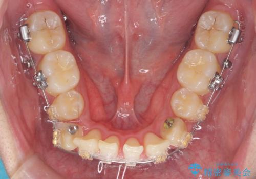 前歯のがたつき 下の八重歯の治療中