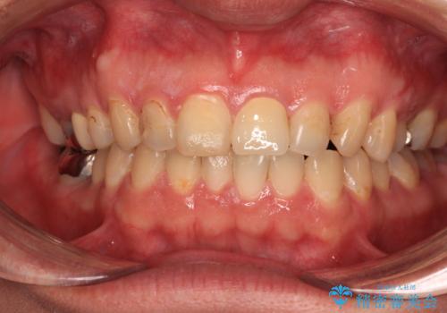 つぎはぎだらけの前歯をオールセラミッククラウンで自然な前歯にの治療後