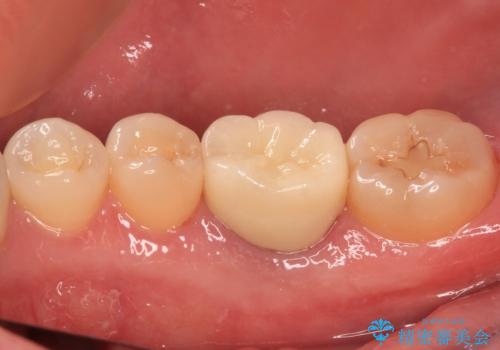 奥歯のむし歯を治したい セラミッククラウンによる補綴治療の治療後