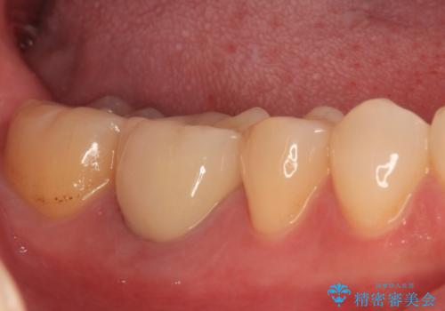 奥歯のむし歯を治したい セラミッククラウンによる補綴治療の治療後