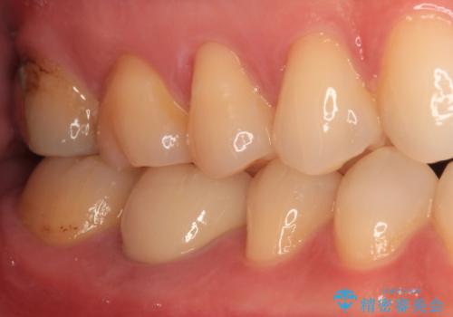 奥歯のむし歯を治したい セラミッククラウンによる補綴治療の治療後