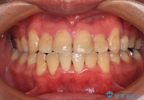 デコボコを治したい 八重歯の抜歯矯正の治療後