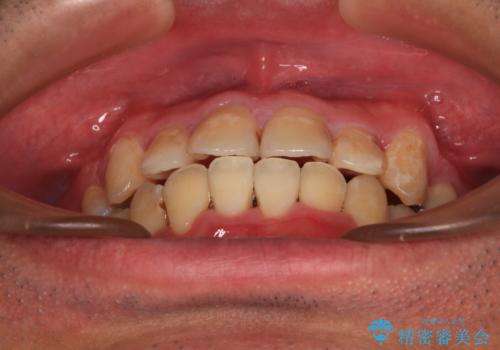 デコボコを治したい　八重歯の抜歯矯正の治療後