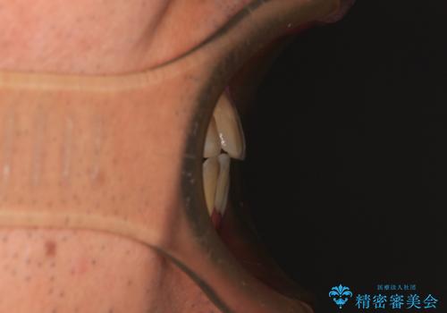 デコボコを治したい 八重歯の抜歯矯正の治療後