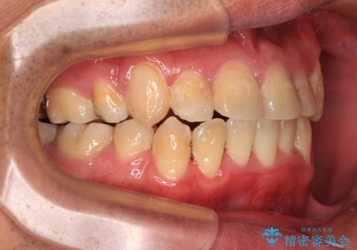 デコボコを治したい　八重歯の抜歯矯正の治療後