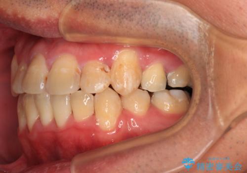 デコボコを治したい 八重歯の抜歯矯正の治療後