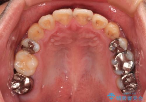 デコボコを治したい 八重歯の抜歯矯正の治療後