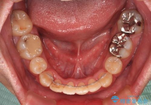 デコボコを治したい 八重歯の抜歯矯正の治療後