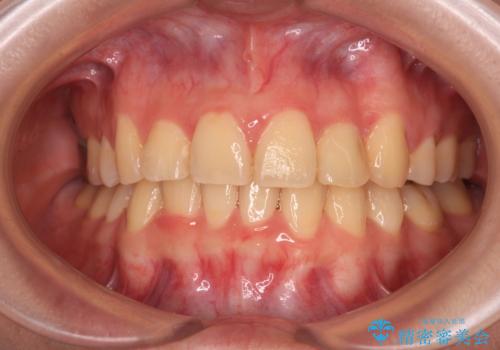 【モニター】再矯正でデコボコの前歯を改善 抜歯矯正の後戻りの症例 治療後