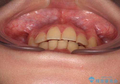 【モニター】再矯正でデコボコの前歯を改善 抜歯矯正の後戻りの治療後