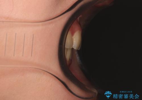 【モニター】再矯正でデコボコの前歯を改善 抜歯矯正の後戻りの治療後