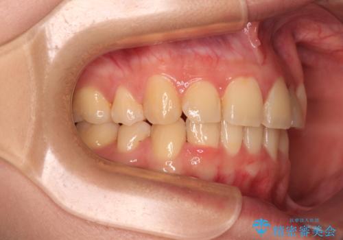 【モニター】再矯正でデコボコの前歯を改善　抜歯矯正の後戻りの治療後