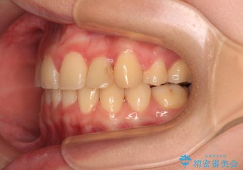 【モニター】再矯正でデコボコの前歯を改善 抜歯矯正の後戻りの治療後