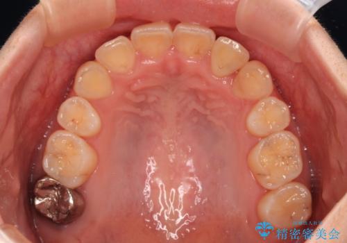 【モニター】再矯正でデコボコの前歯を改善 抜歯矯正の後戻りの治療後