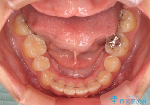 【モニター】再矯正でデコボコの前歯を改善 抜歯矯正の後戻りの治療後