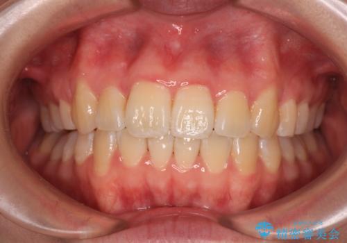 【モニター】八重歯を片側の抜歯矯正で治す メタルブラケット装置の症例 治療後
