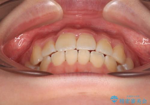【モニター】八重歯を片側の抜歯矯正で治す　メタルブラケット装置の治療後