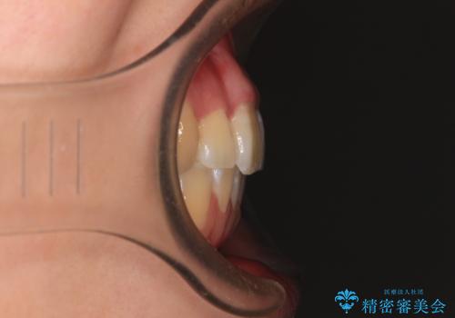 【モニター】八重歯を片側の抜歯矯正で治す メタルブラケット装置の治療後