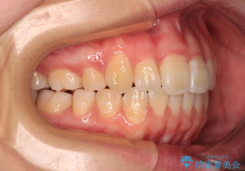 【モニター】八重歯を片側の抜歯矯正で治す メタルブラケット装置の治療後