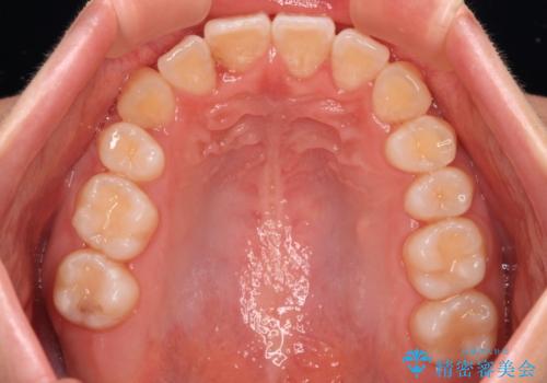 【モニター】八重歯を片側の抜歯矯正で治す メタルブラケット装置の治療後