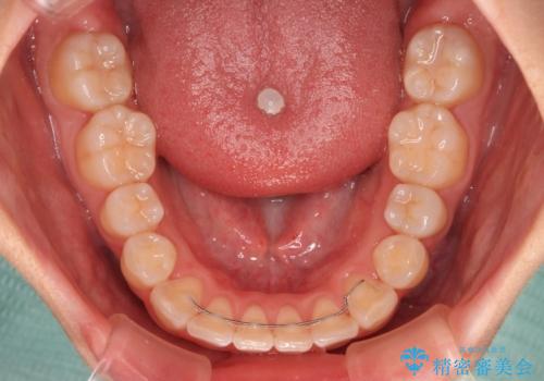 【モニター】八重歯を片側の抜歯矯正で治す メタルブラケット装置の治療後