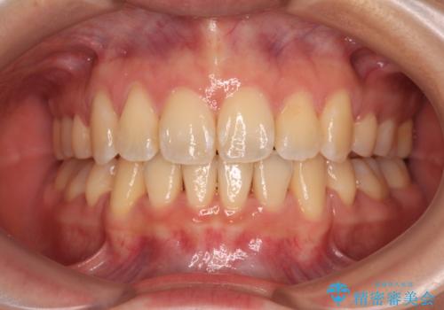 閉じにくい口元を抜歯矯正ですっきりと