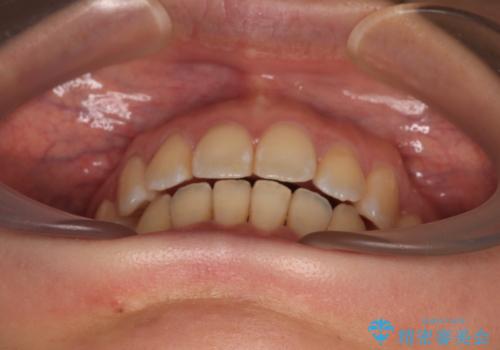 閉じにくい口元を抜歯矯正ですっきりとの治療後