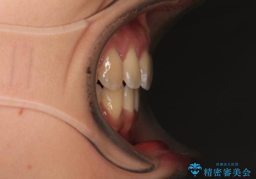 閉じにくい口元を抜歯矯正ですっきりとの治療後