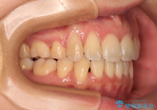 閉じにくい口元を抜歯矯正ですっきりとの治療後